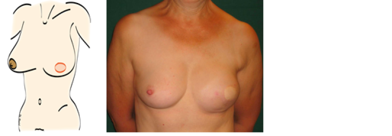 mastectomy2