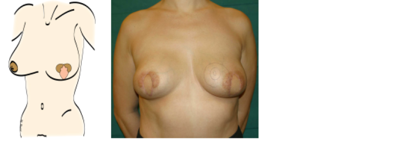 mastectomy3